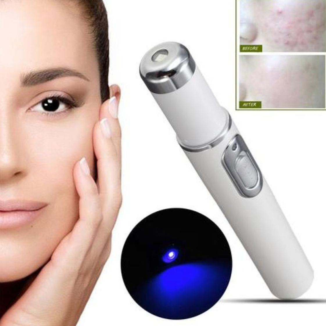 Blue Light Therapy Acne Laser Pen Soft Scar Wrinkle Removal Treatment Device Skin Care Beauty Equipment